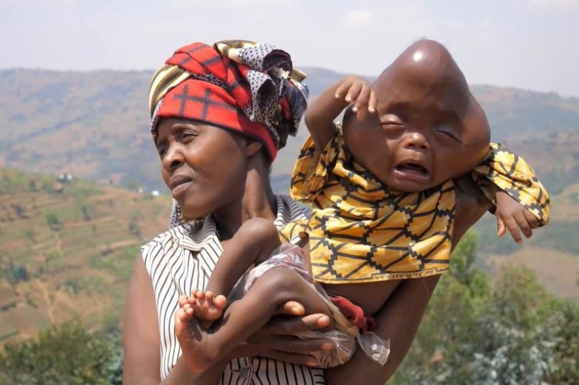 Relatives refused an African woman who gave birth to a baby with a head in the shape of a pear