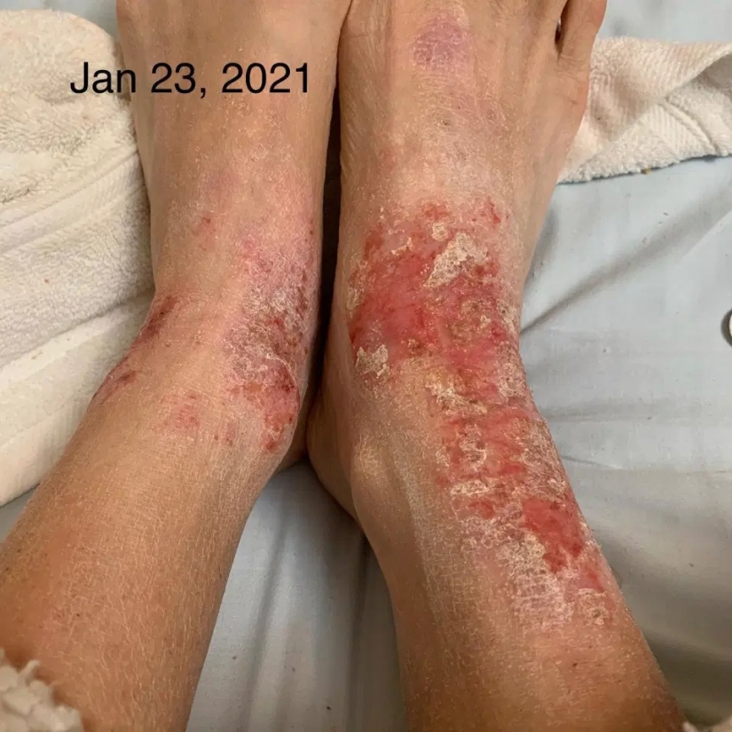 Side effect: an American woman has endured terrible suffering because of steroids to treat eczema