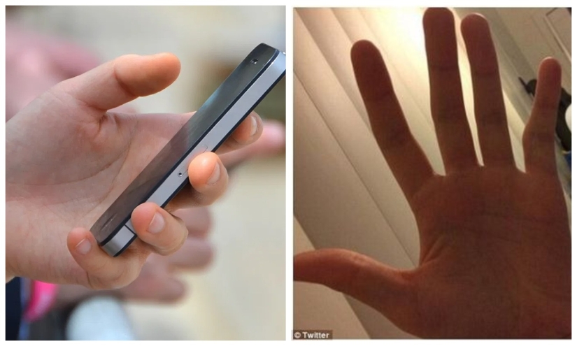 Smart Pinky: los usuarios de teléfonos inteligentes están experimentando cada vez más deformidad en los dedos