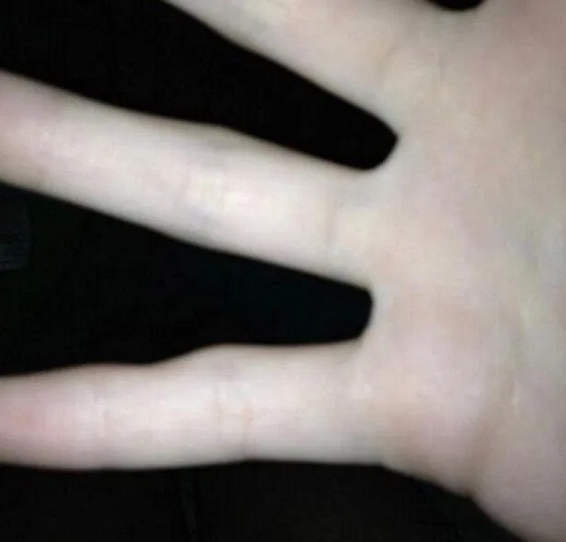 Smart Pinky: smartphone users are increasingly experiencing finger deformity