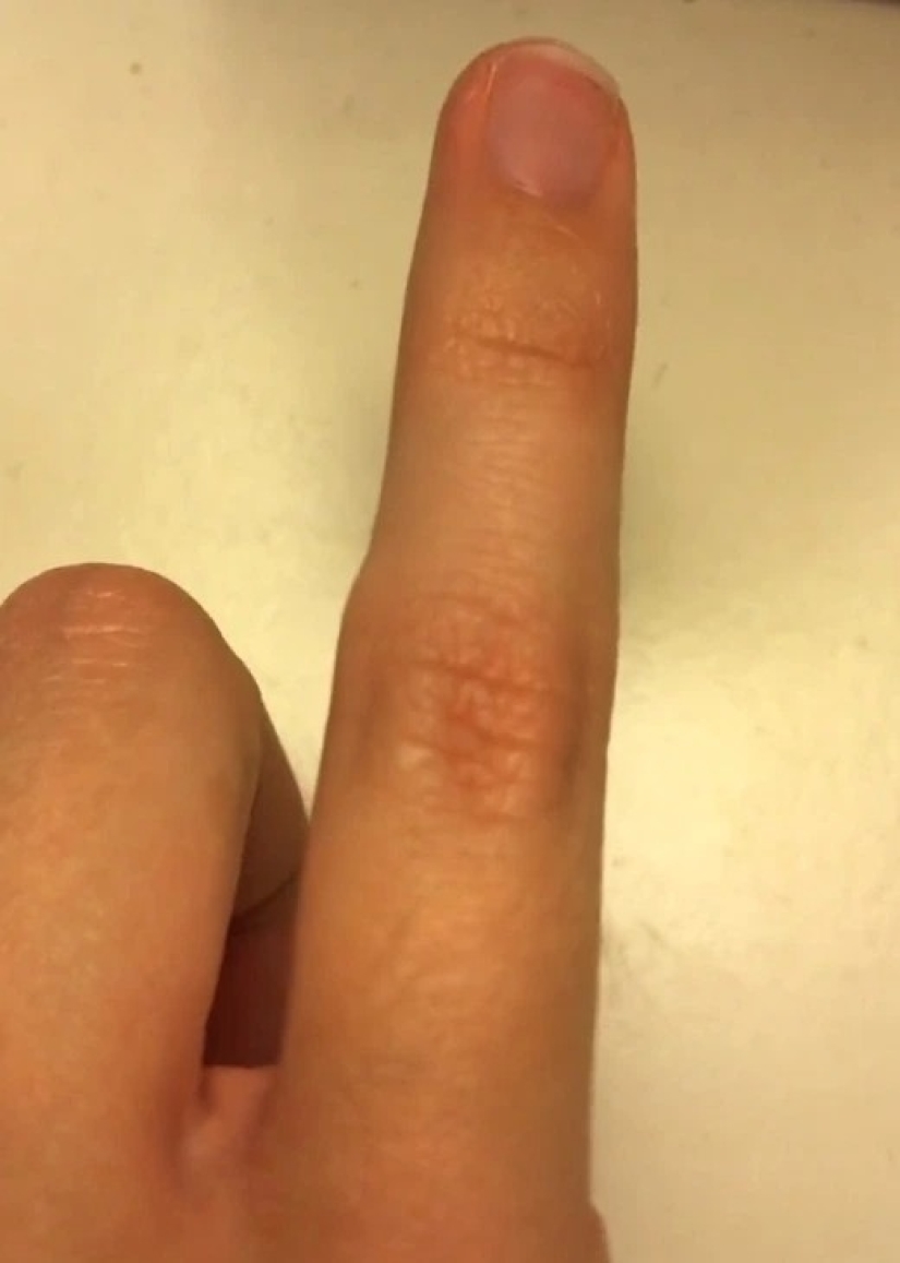 Smart Pinky: smartphone users are increasingly experiencing finger deformity
