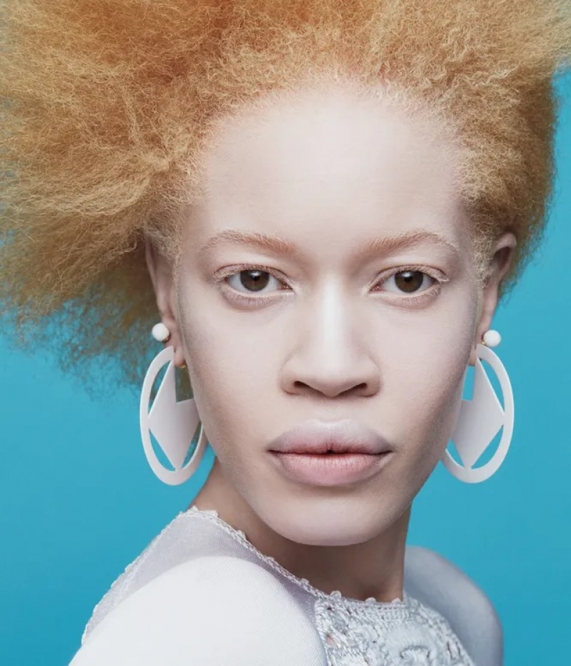 Strabismus, albinism, age: 5 models who tear the beauty template