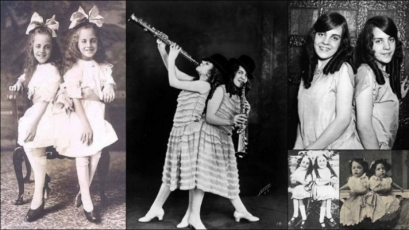 The life of Siamese twins Daisy and Violet Hilton