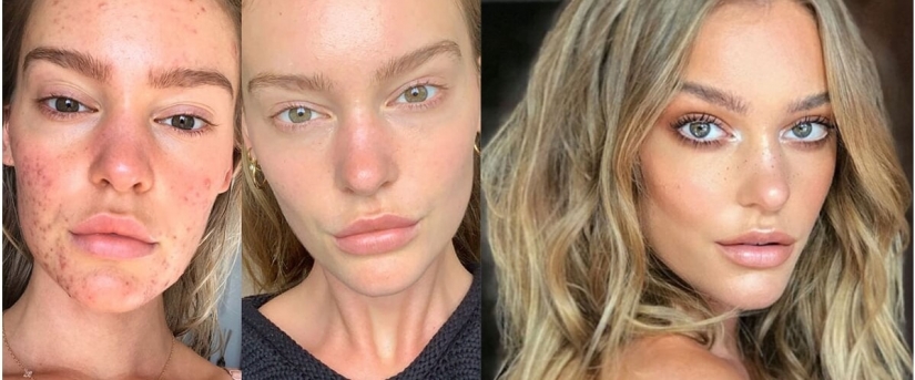 The result is obvious: the Sports Illustrated model got rid of acne, thanks to nutrition and meditation