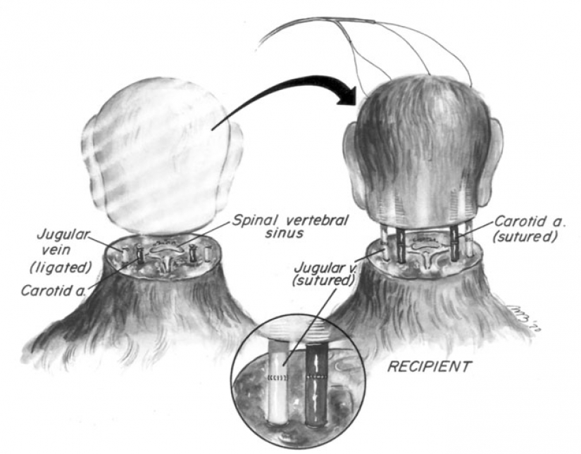 The story of a head transplant that was never meant to happen