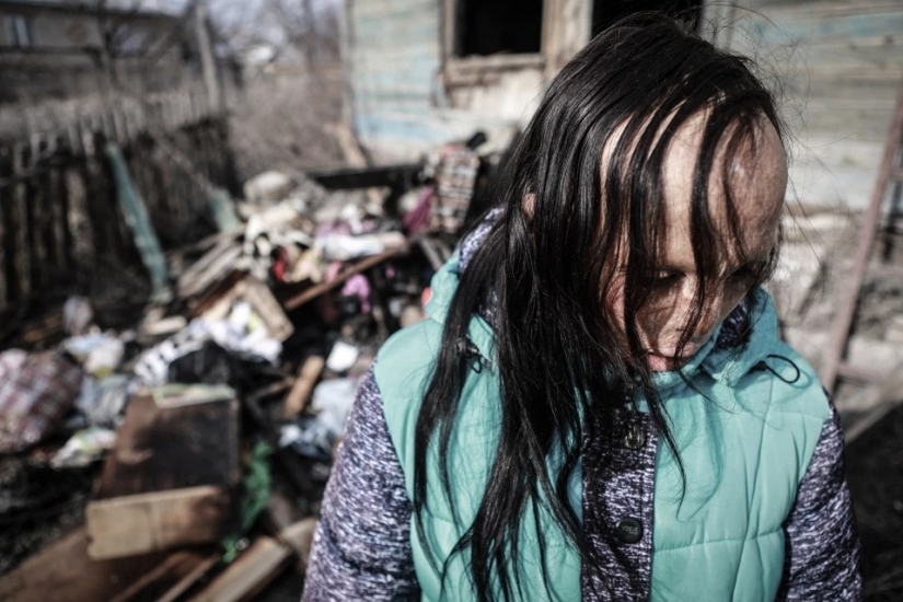 The story of Ani boldyrevoy, which has lost face because of the fire, but hopes for a better life