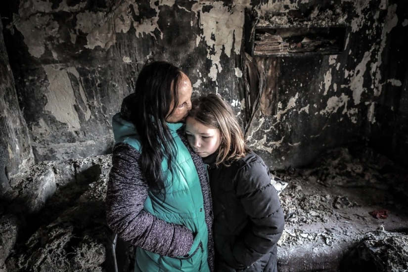 The story of Ani boldyrevoy, which has lost face because of the fire, but hopes for a better life