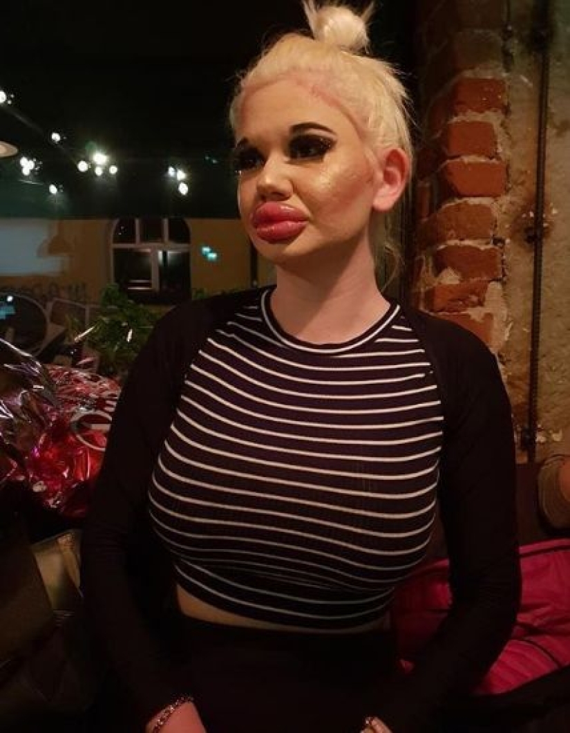 The woman with the biggest lips in the world is going to enlarge her cheeks