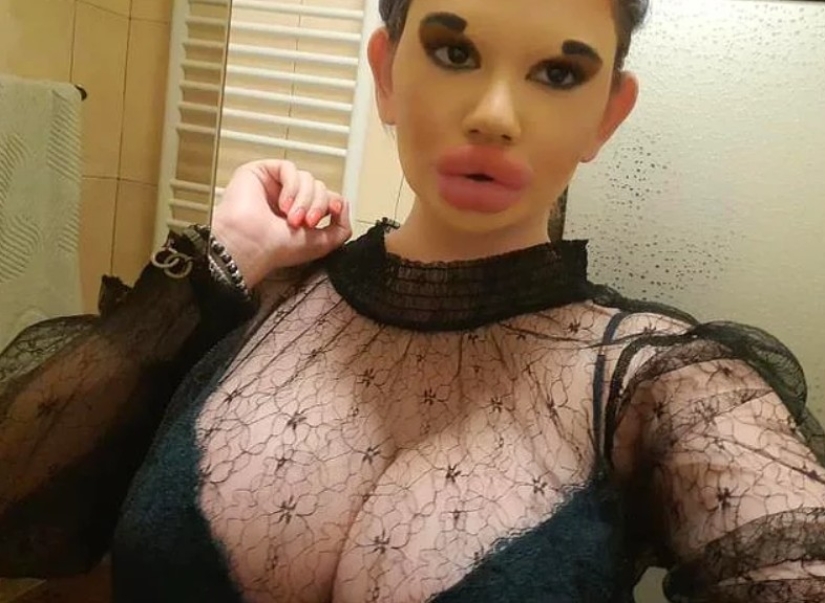 The woman with the biggest lips in the world is going to enlarge her cheeks