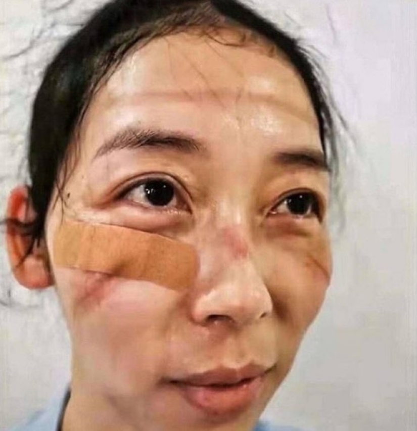 "These wounds will not go away — they will remain inside us": photos of medical girls with traces of masks on their faces