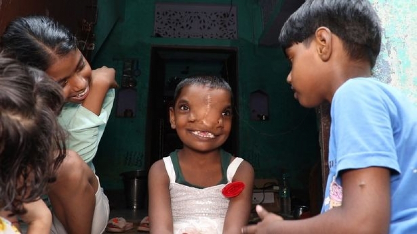 Una niña con dos narices en la India es considerada la encarnación de una deidad