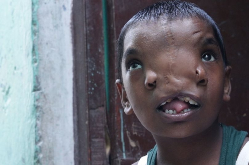 Una niña con dos narices en la India es considerada la encarnación de una deidad