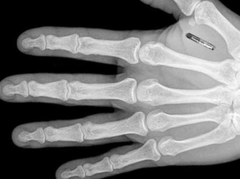 Why the Swedes massively and voluntarily implanted under the skin microchips