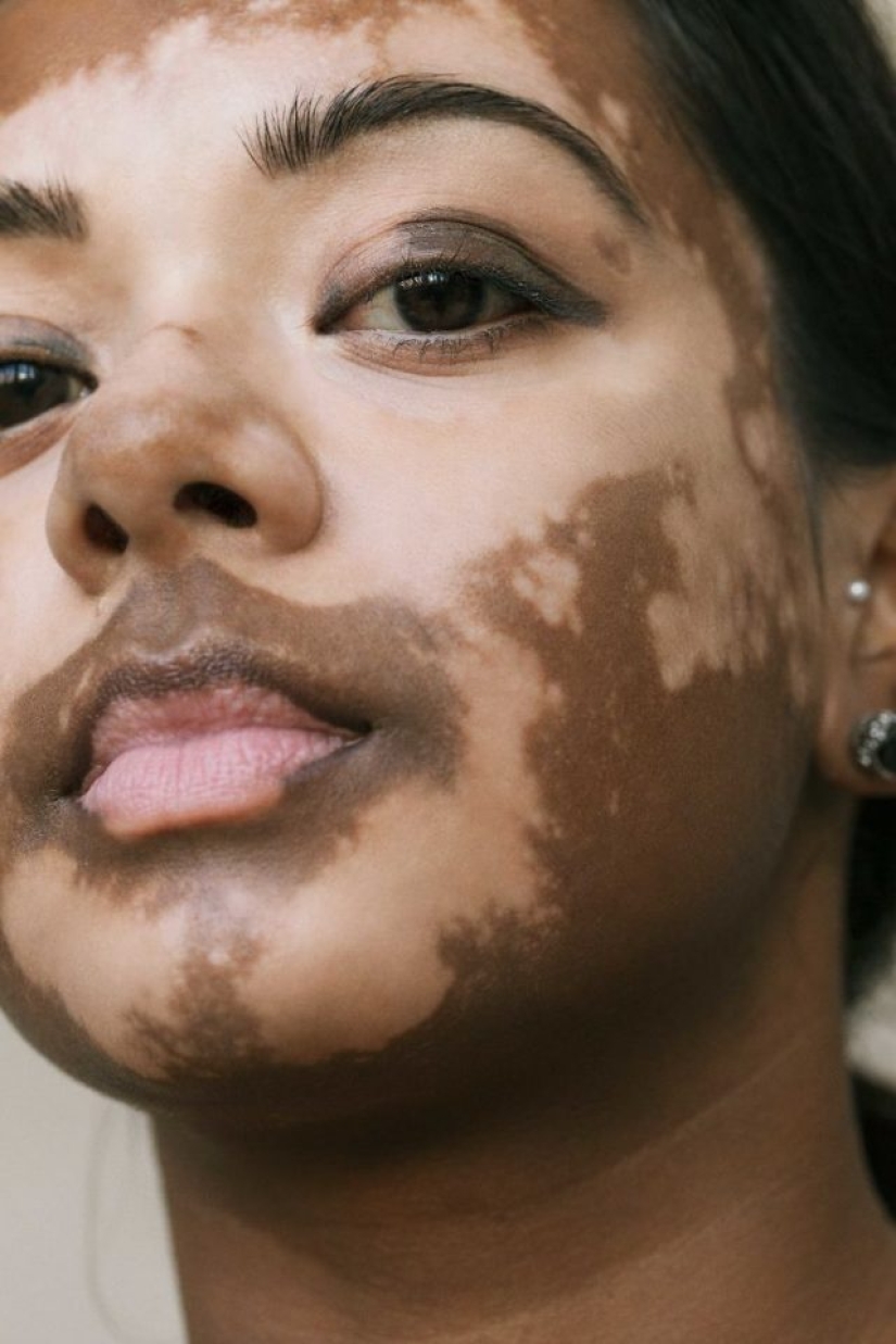 10 beautiful women with vitiligo, photographed by a photographer with the same condition
