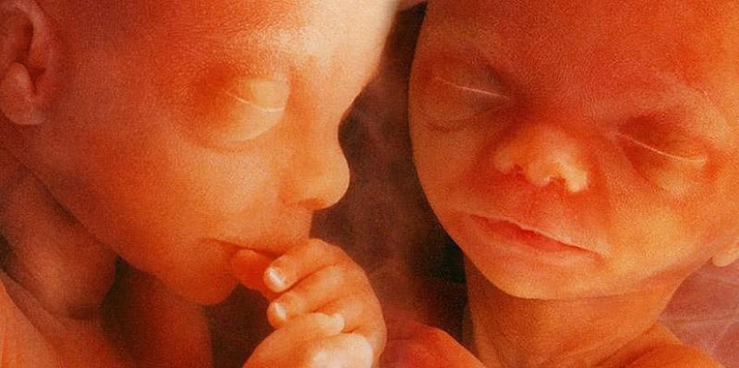 10 incredible true stories about twins