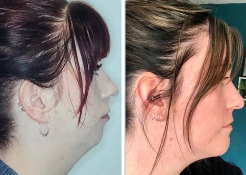 22 photos of people who went under the surgeon's knife and never regretted it