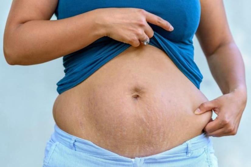 5 reasons for a large belly, not related to regular overeating