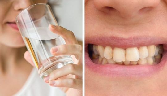 6 Reasons Your Teeth May Be Staining