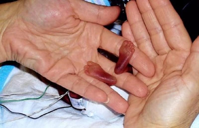 7 incredible stories of survival of babies