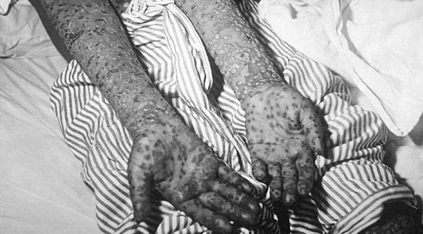 7 of the worst epidemics in human history
