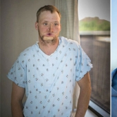 A failed suicide had his face transplanted, and a new life began for him