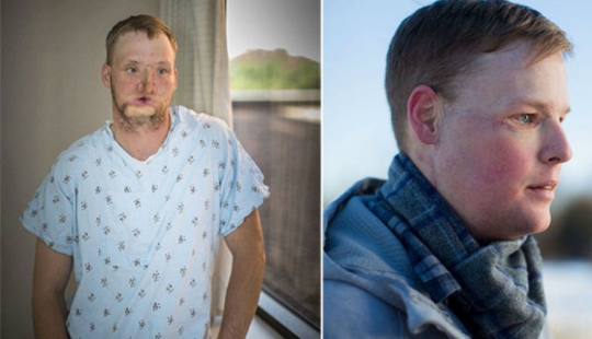 A failed suicide had his face transplanted, and a new life began for him