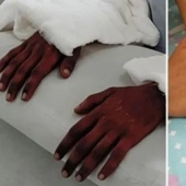 A girl from India was transplanted male hands, a year later they lightened and lost their hair