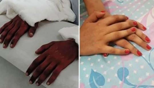 A girl from India was transplanted male hands, a year later they lightened and lost their hair