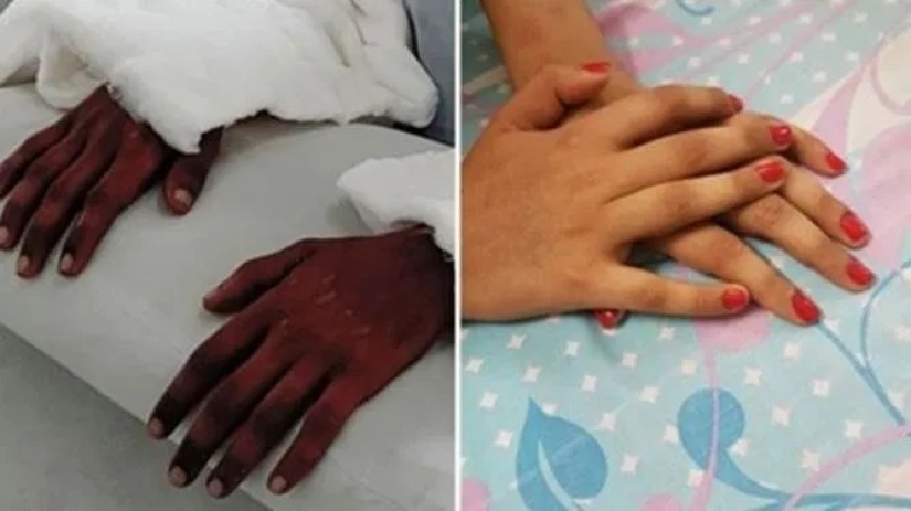 A una niña de la India le trasplantaron manos masculinas, un año después se aclararon y perdieron el cabello
