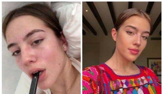 A young American woman almost became disabled due to vaping A young American woman almost became disabled due to vaping