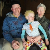 African albinos do not hide their fears