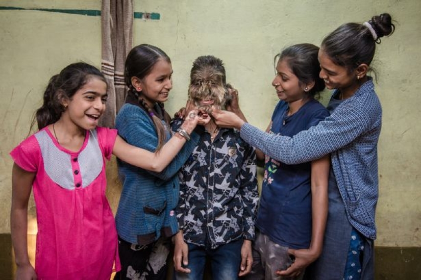 Amable y esponjoso: Un niño de 13 años de la India sufre del "síndrome del hombre lobo"