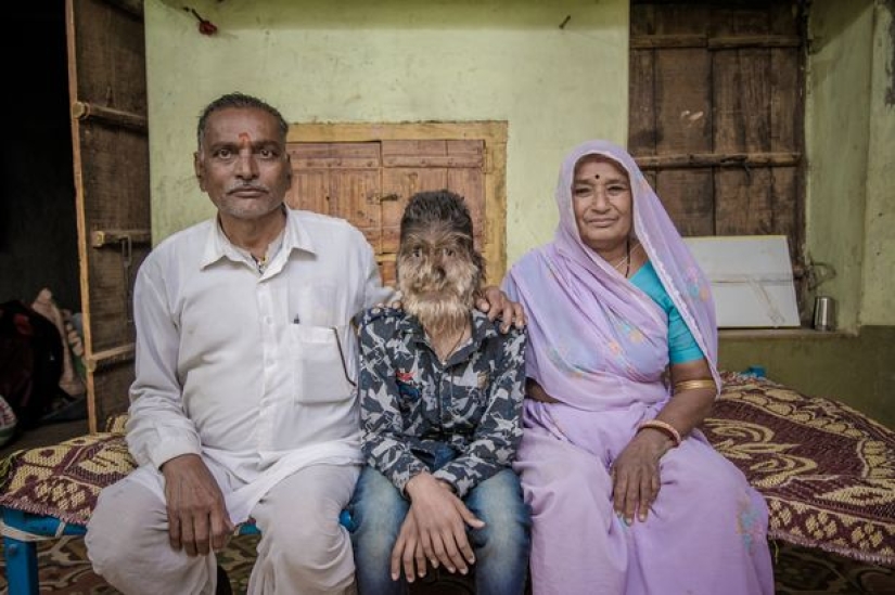 Amable y esponjoso: Un niño de 13 años de la India sufre del "síndrome del hombre lobo"
