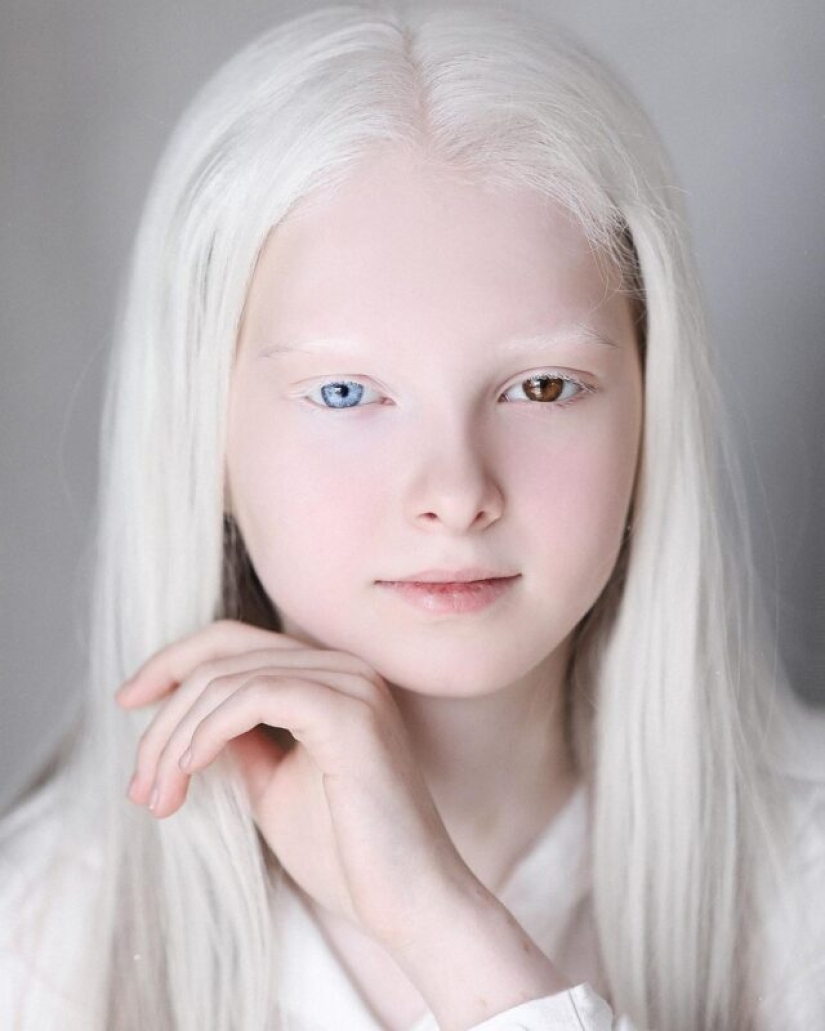 An albino girl from Chechnya struck with her unique appearance