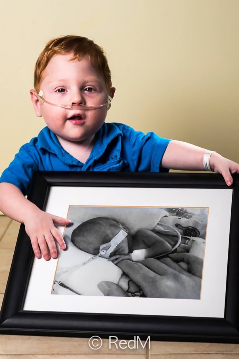 Antes y después: fotos fuertes de niños que nacieron prematuramente