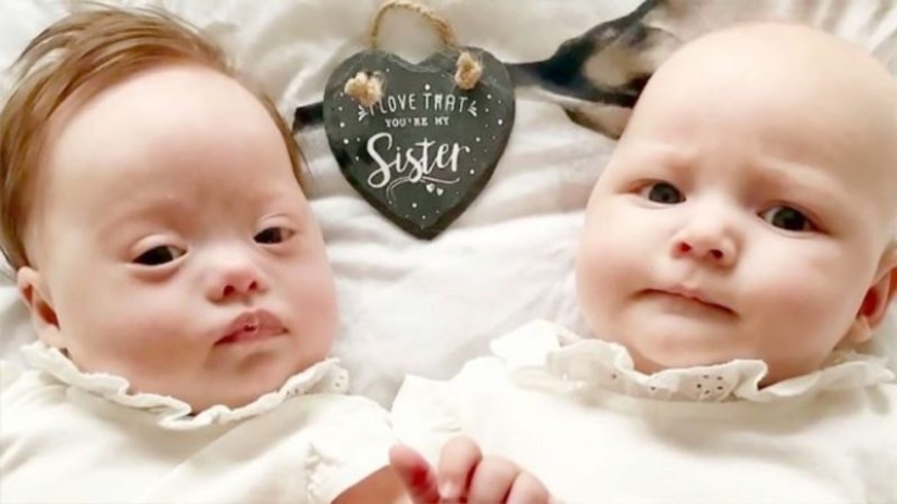 "Babies in a million": a British couple had unique twin girls