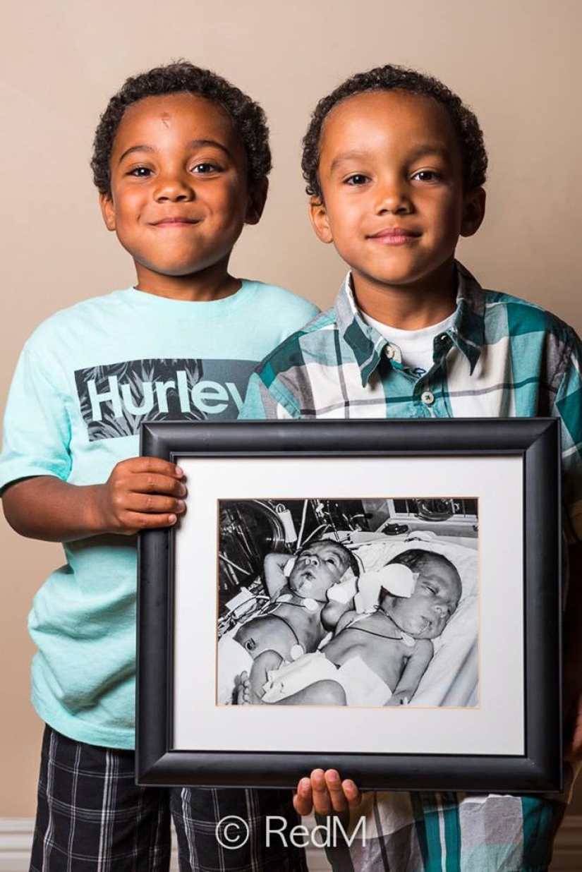 Before and after: strong photos of children who were born prematurely