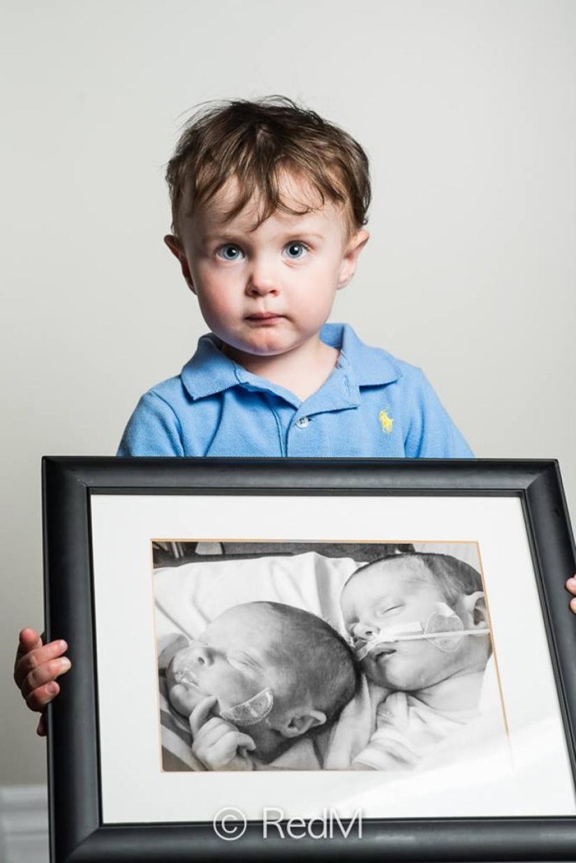 Before and after: strong photos of children who were born prematurely