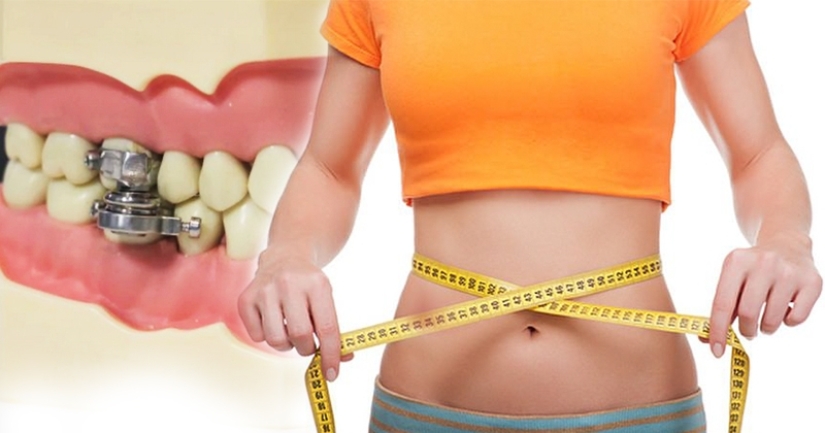 Boca cerrada: científicos de Nueva Zelanda han ideado una manera ingeniosa de perder peso
