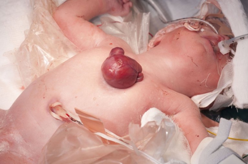 British doctors saved a baby girl who was born with her heart out