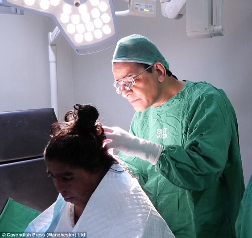 British surgeon performs free eyebrow transplantation for acid attack victims