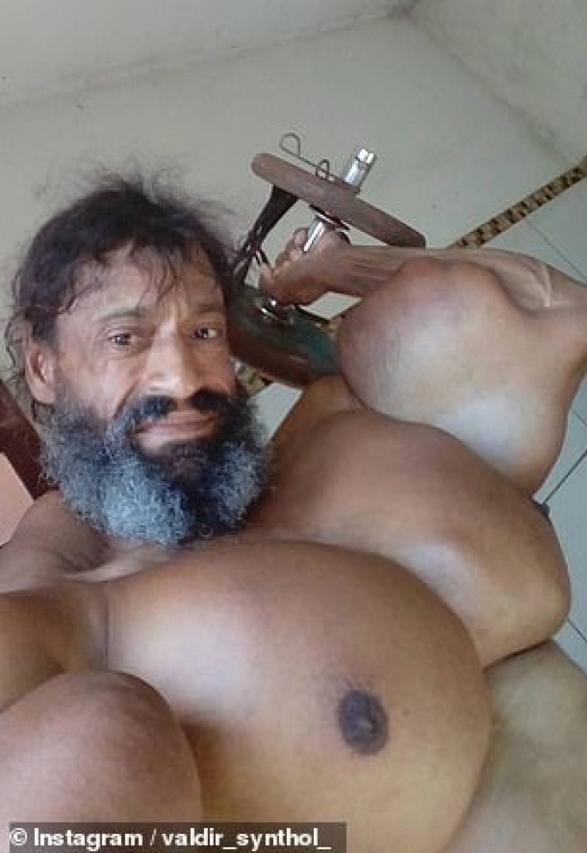 Bulbosaurus from Brazil: former drug addict gives himself oil injections