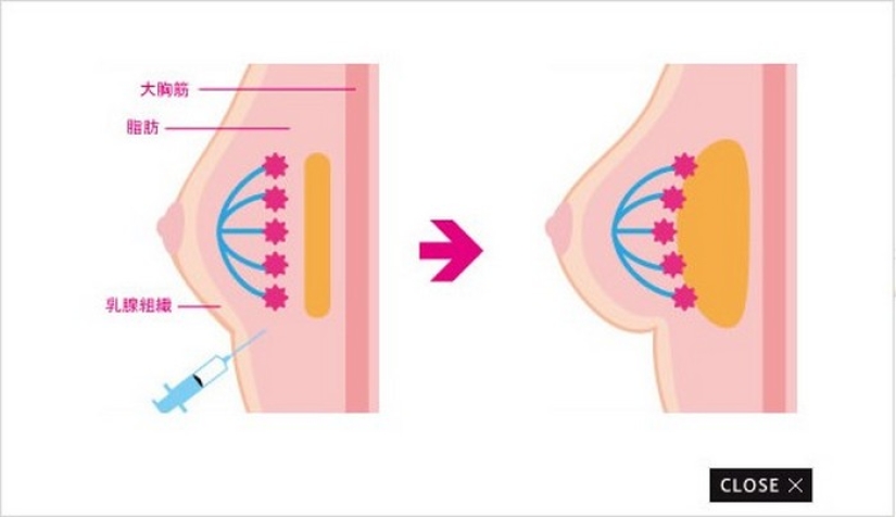 "Cirugía plástica de cenicienta": las japonesas practican el aumento de senos por un día