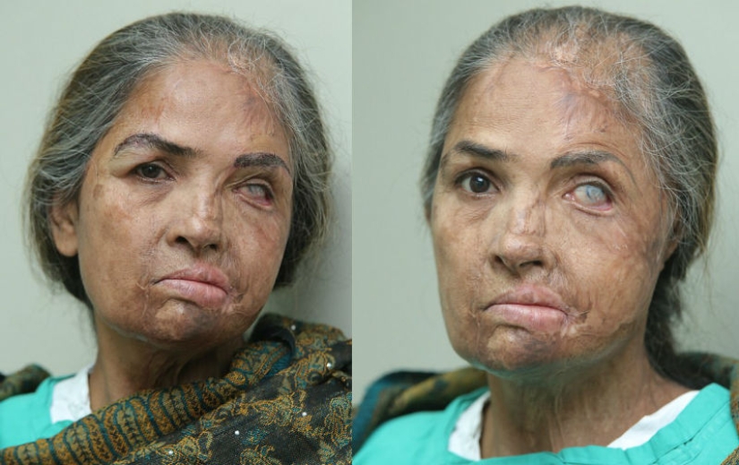 Cirujano británico realiza trasplante de cejas gratuito para víctimas de ataques con ácido