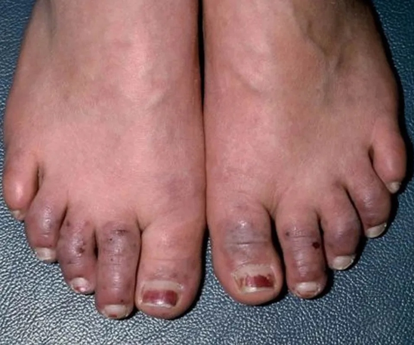 Cómo los pies muestran el estado de salud: 8 señales sobre enfermedades graves