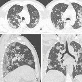 Cómo son los pulmones afectados por el coronavirus