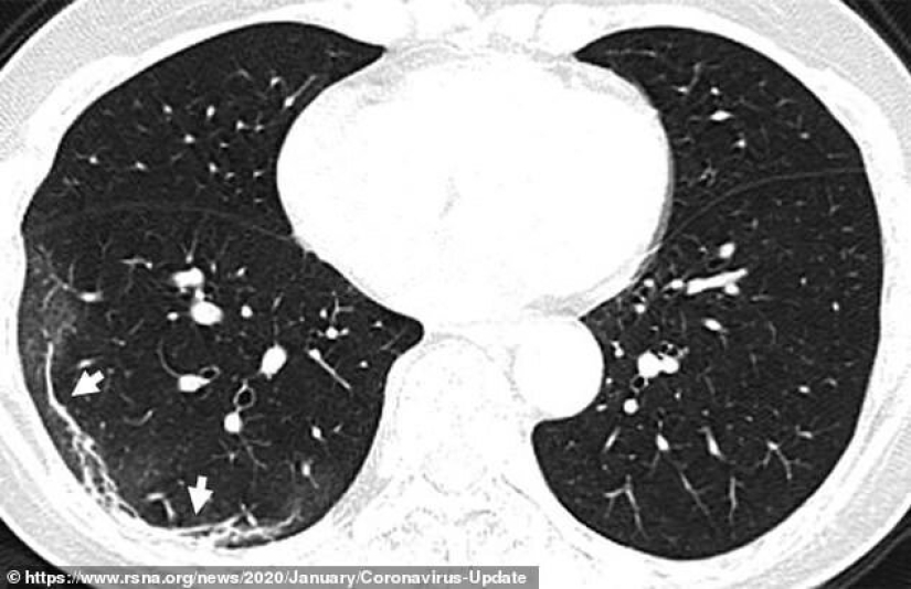 Cómo son los pulmones afectados por el coronavirus
