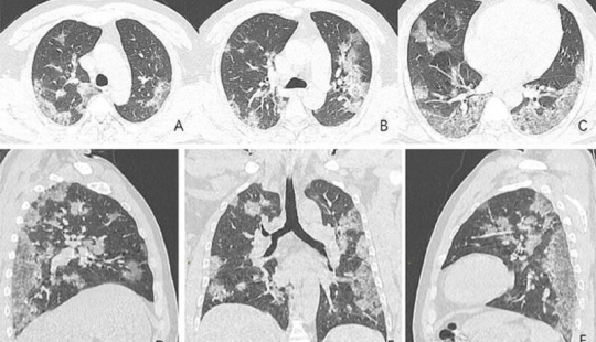 Cómo son los pulmones afectados por el coronavirus