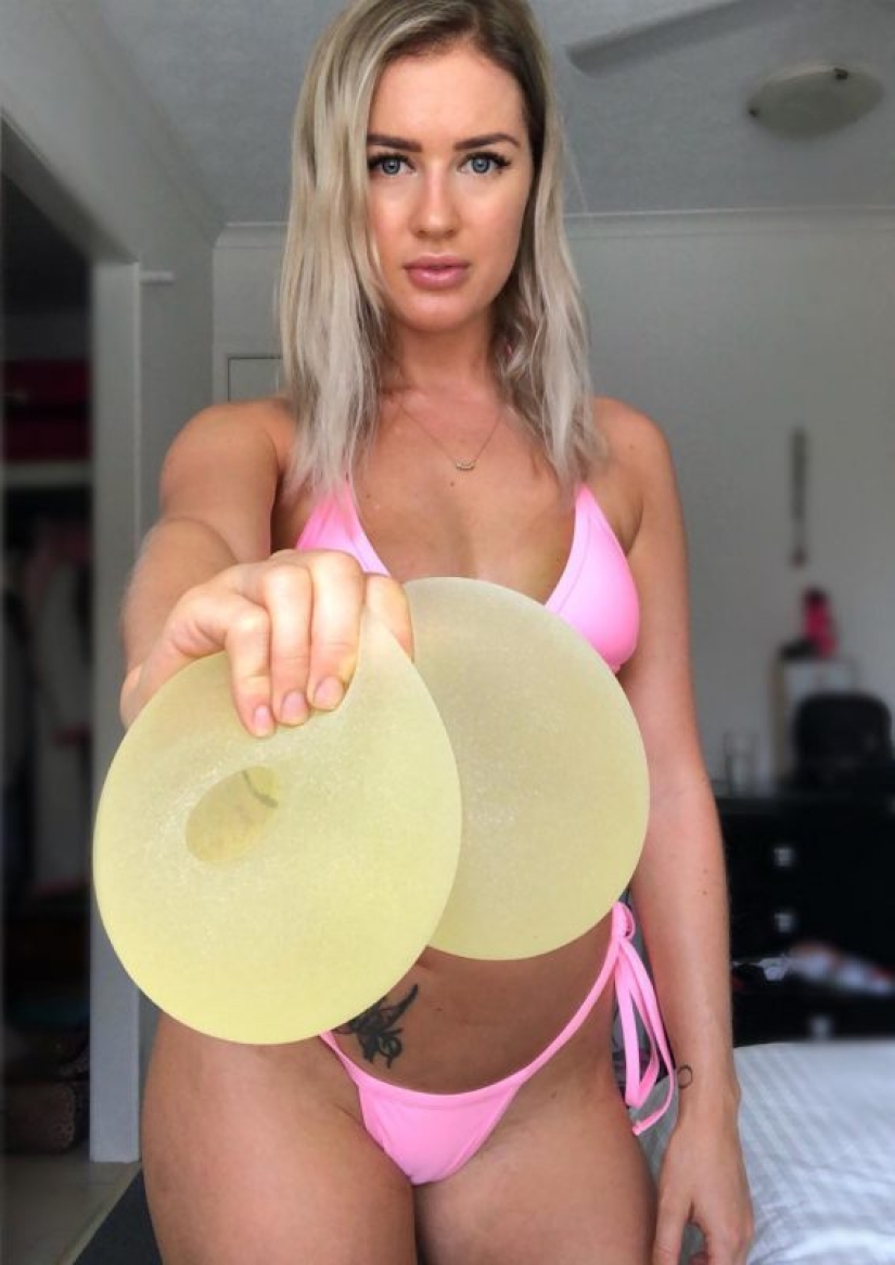 Como una piedra del alma: una mujer australiana se quitó la silicona de los senos porque interfería con su vida sexual