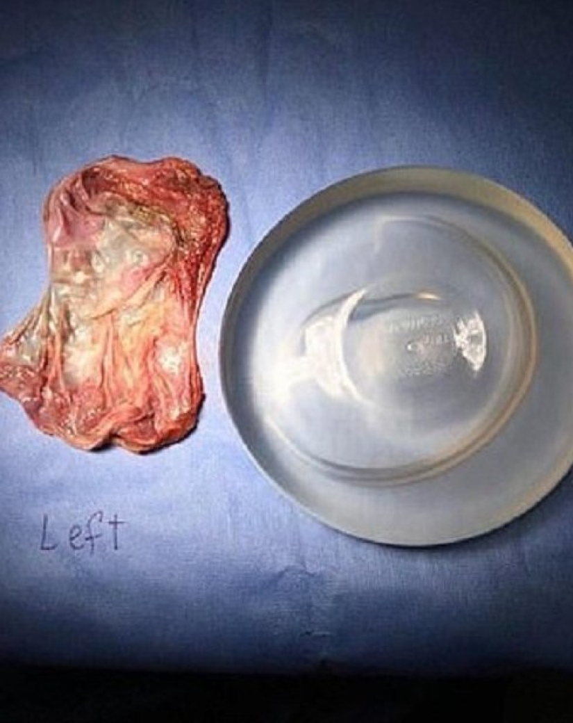 "Con ellos, mi vida se convirtió en un infierno": una mujer australiana contó por qué se deshizo de los implantes mamarios